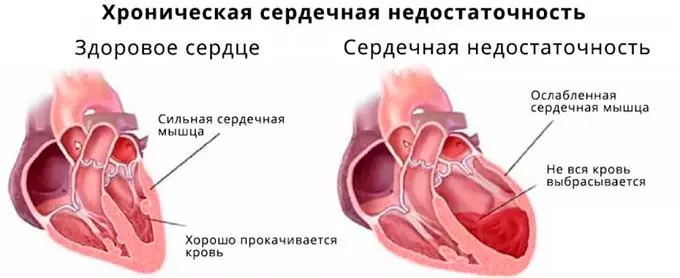 Риски 3 степени Сердечная недостаточность