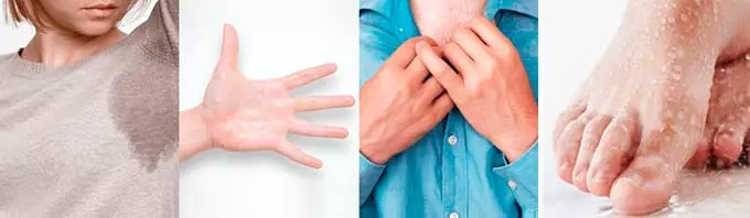 Основные зоны гипргидроза