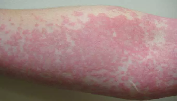 Крапивница на коже руки