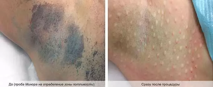 Лечение гипергидроза уколами ботокса