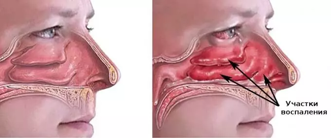 Какими последствиями опасны капли от насморка при гипертонии Заложенный и здоровый нос