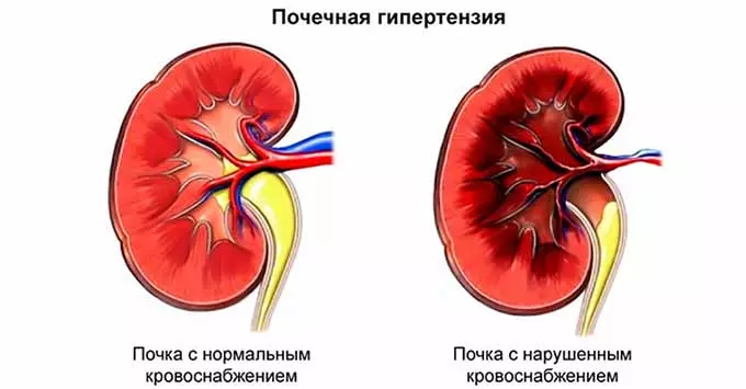 Почечная АГ Почечная гипертония
