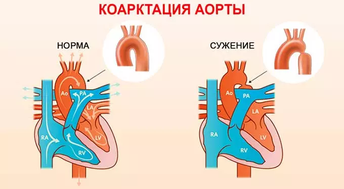 коарктация аорты коарктация аорты