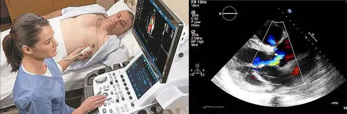 Как проводится диагностика отклонения УЗИ сердца